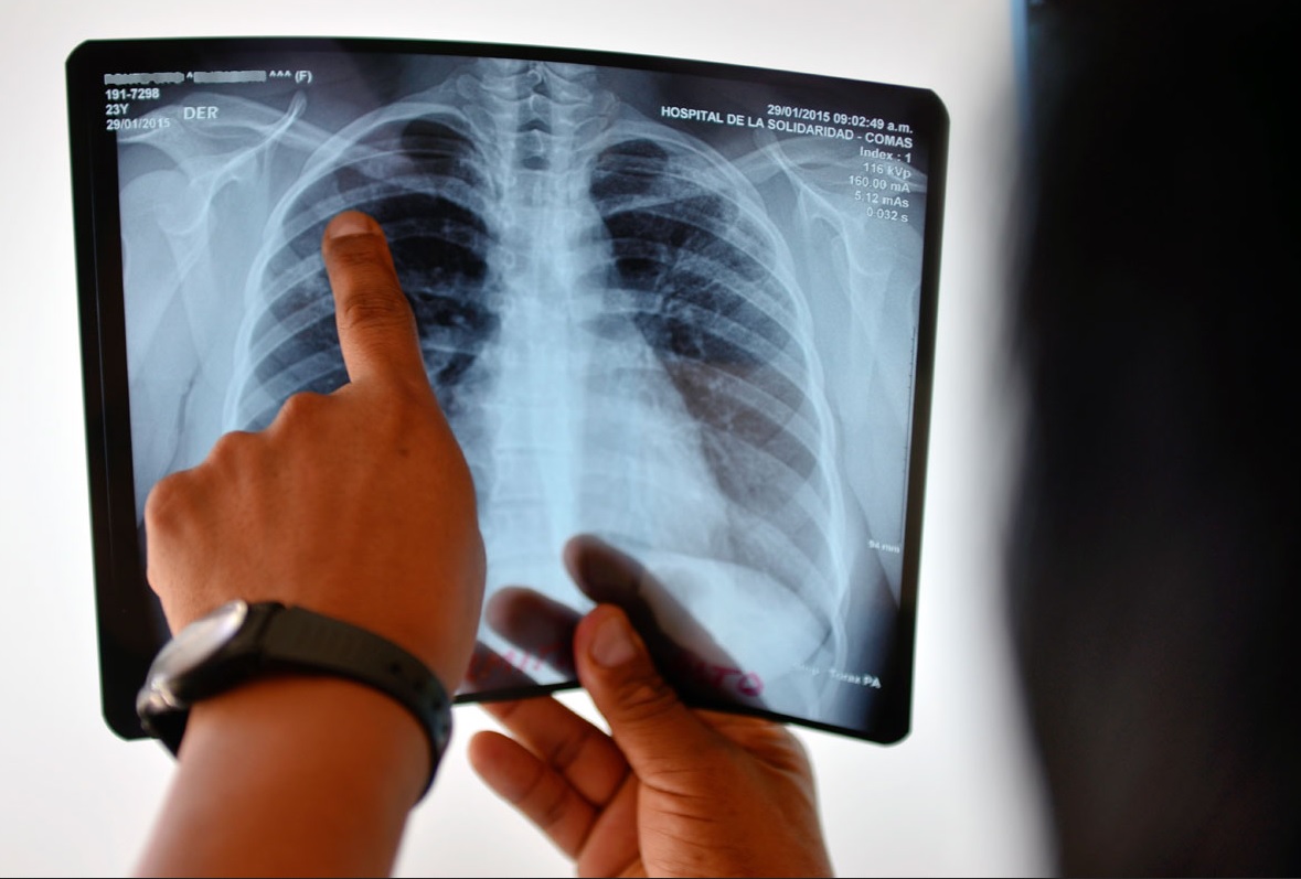 Tuberculosis en colegios de Argentina